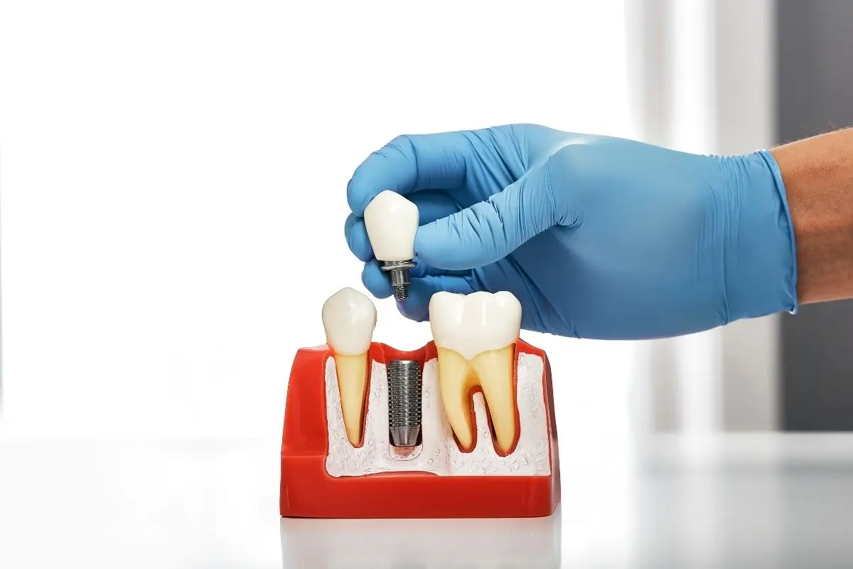 jak wygląda implant zęba